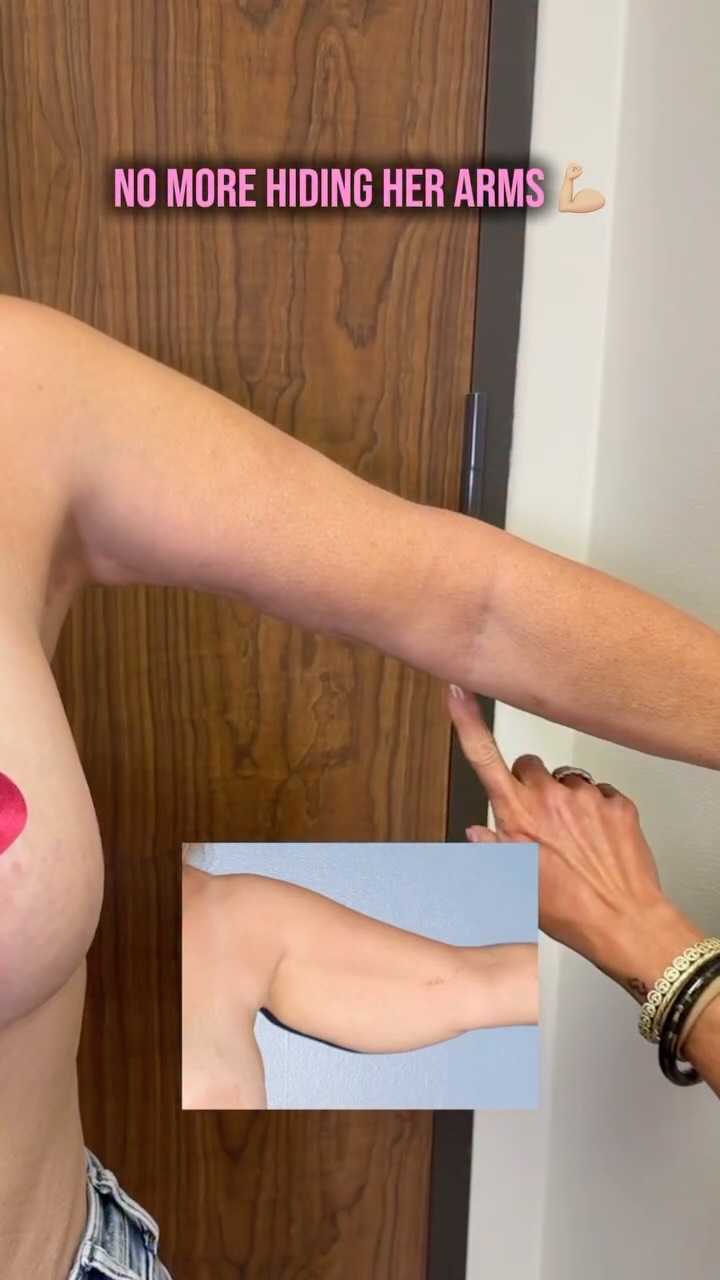 Arm lift results that speak for themselves 🤍
This is one of those procedures that completely changes how a woman moves through the world. The way she gets dressed, the way she poses in photos, the way she feels in her own skin.
She has now entered her sleeveless tops era and she deserves every second of it! ✨
📍 @memorialplasticsurgery | #armlift #brachioplasty #femaleplasticsurgeon #beforeandafter #houstontx