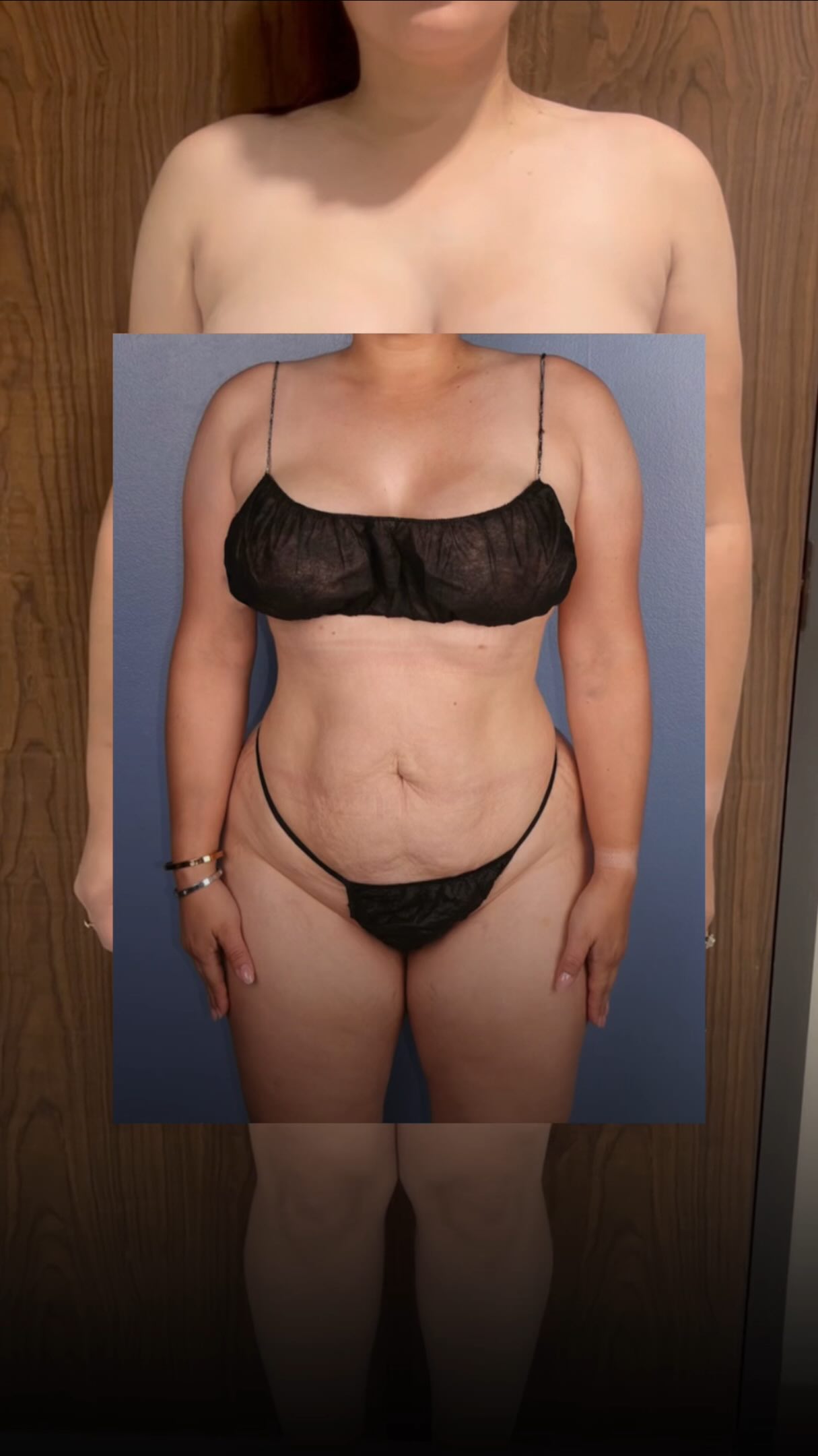 Gorgeous 6 week result from this week’s clinic 💗
📍 @memorialplasticsurgery | #femaleplasticsurgeon #beforeandafter #mommymakeover #plasticsurgery