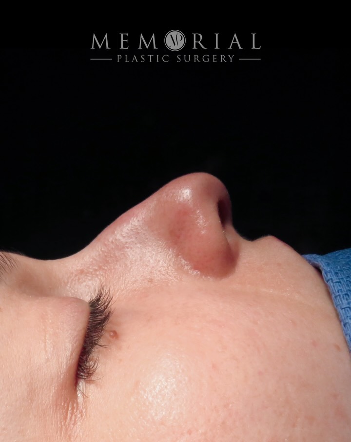 Straight from the OR. 👃🏻
She came in with a curved C-shaped dorsal deformity and a tip that needed rotation and refinement. No obstruction concerns — purely cosmetic, and a very clear vision of what she wanted.
First surgery ever. First time under anesthesia. And she trusted us with her face, and we both couldn’t be happier with these early results.
Procedure(s) performed:
🔹 Rhinoplasty
🔹 Septoplasty
Questions below 💬