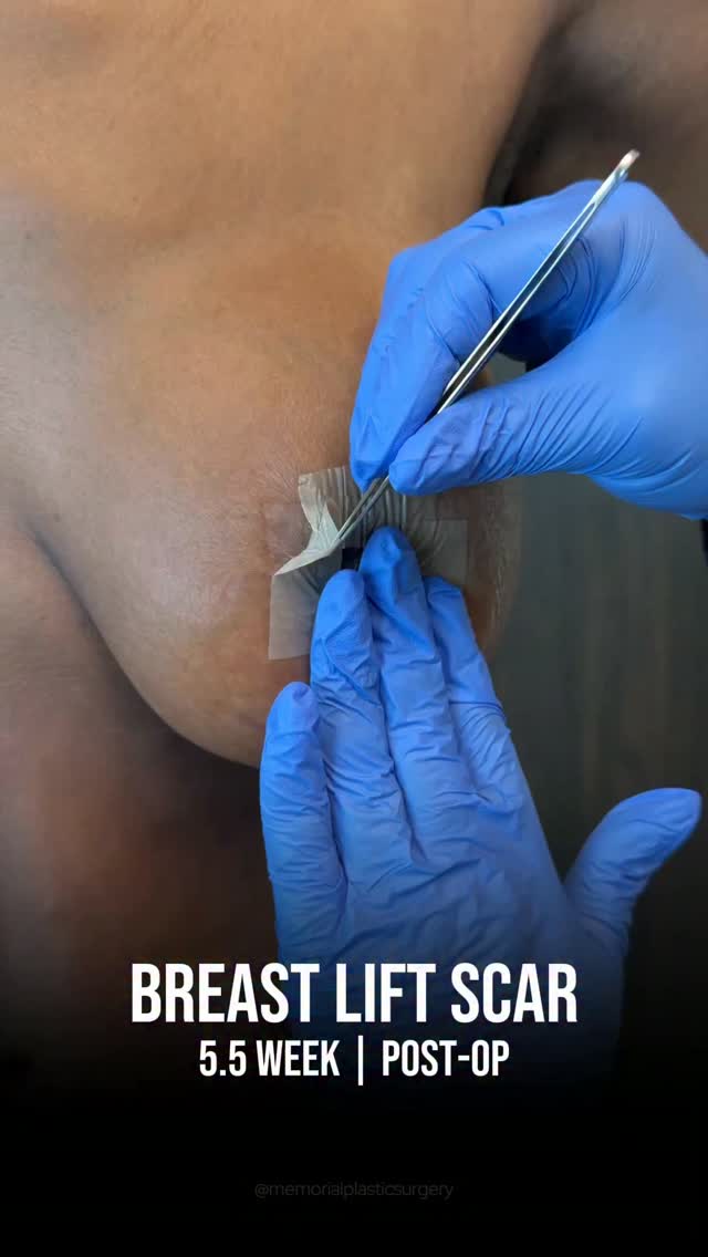 5.5 weeks #postweightloss breast lift. Scar reveal + full result. ☝🏻

Her goal was a natural lift with a modest size increase. 335cc full profile implants, bilateral mastopexy — and the scars are healing exactly as planned.

Still fading. Already love this result. 🙏🏼

Procedures: Bilateral Mastopexy & Breast Augmentation — 335cc Full Profile Implants

📍 @memorialplasticsurgery | #breastaugmentation #mastopexy #houstonplasticsurgeon