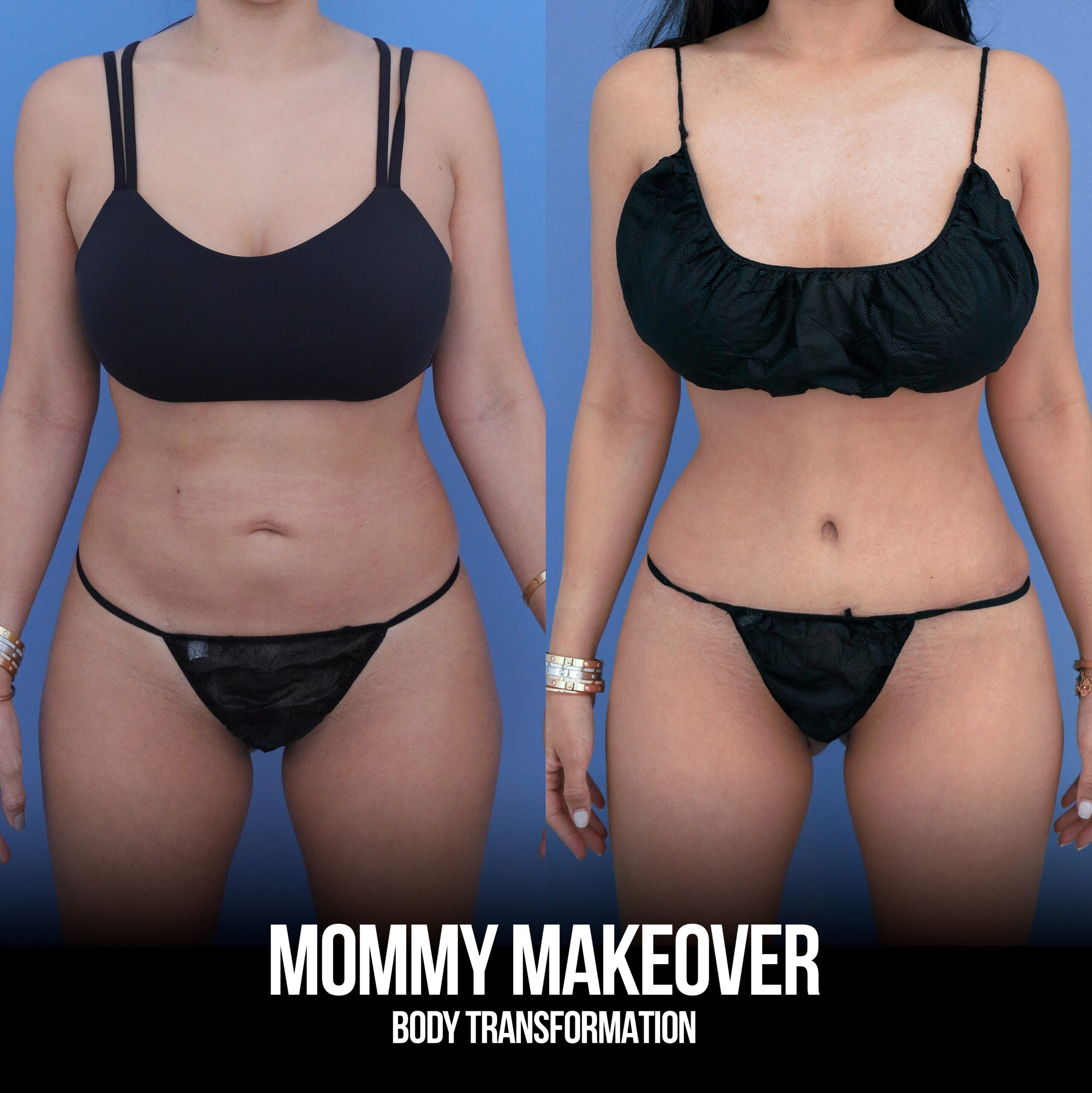 Most people don’t realize that a tummy tuck is about more than the skin. ☝🏻

For this patient — a mom of 2 — the muscle separation from her pregnancies was just as important to address as the excess skin. We repaired the diastasis recti, tightened the abdomen, and contoured the flanks for a complete result.

This is where she is now 7 months later. 🔥

Procedures: Tummy Tuck with Diastasis Recti Repair, Lipo to Abdomen & Bilateral Flanks

(Pre-Sx Wt: 121 | Ht: 5’0 | BMI: 23.6)

📍 @memorialplasticsurgery | #tummytuck #mommymakeover #houstonplasticsurgeon