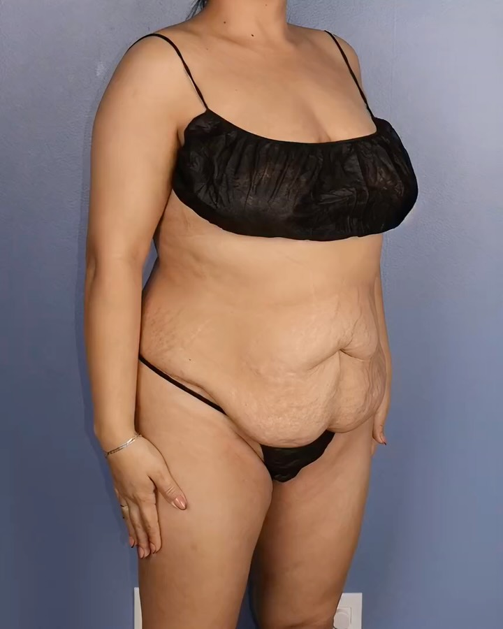 Before surgery and at the four month mark. 🤍

BBL, lipo 360 and abdominoplasty — and she is fully healed, fully settled and absolutely stunning. The hourglass we built together is showing up in every single angle.

So proud of her and how far she’s come 🫶

#mommymakeover #beforeandafter #femaleplasticsurgeon