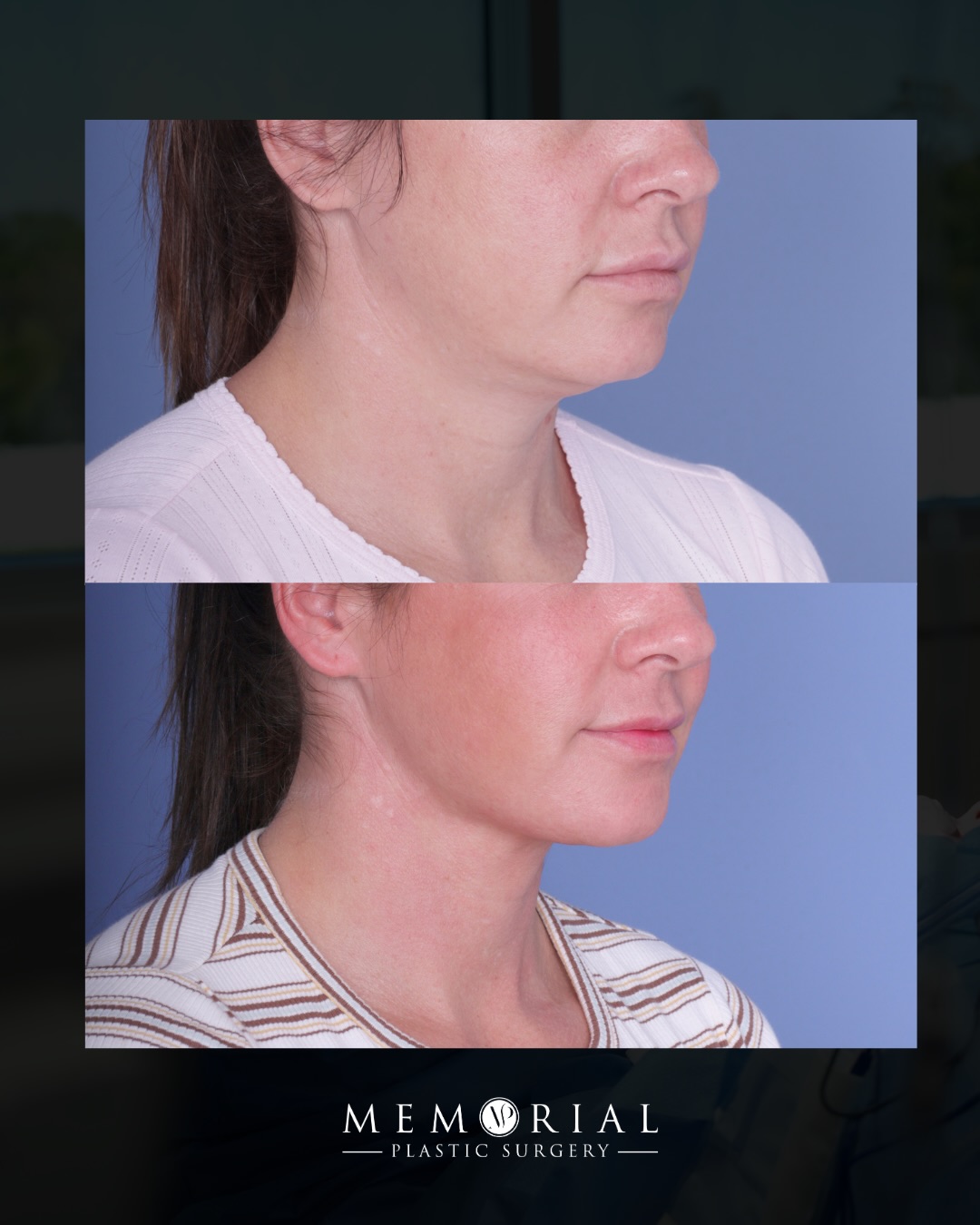 2.5 months out. And all this through one little incision under the chin.
She came in with one specific concern — fullness under the chin and along the neck that wasn’t going anywhere on its own no matter how much we exercised or worked at it.
We addressed it at every layer. Fat, muscle, and the deeper structures that define that sharp cervicomental angle.
Procedure(s) performed:
🔹 Deep neck lift
🔹 A gentle bit of submental liposuction
Questions about this procedure? All below 💬
📍 @memorialplasticsurgery | #houstonplasticsurgeon #necklift