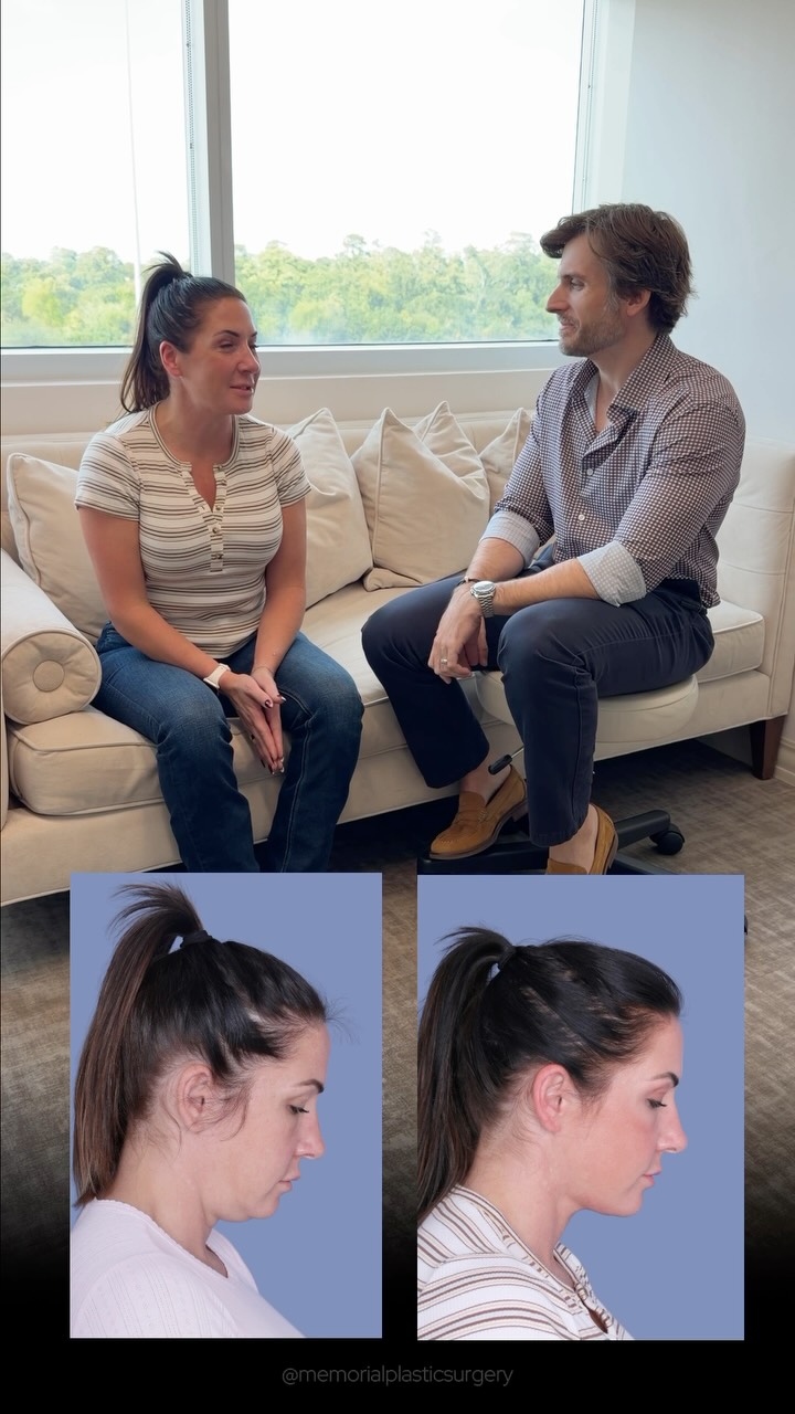Testimonial Tuesday 🎙️
Unscripted. Unedited.
From “always chasing more Botox just to keep my eyes open” — to “I should have done it sooner.”
2 months out — wearing her hair up, skipping the Botox, and finally getting her eyeliner to land where it’s supposed to.
The little things add up. 🤍
As always, I’m here for questions 💬
📍 @memorialplasticsurgery | #houstonplasticsurgeon