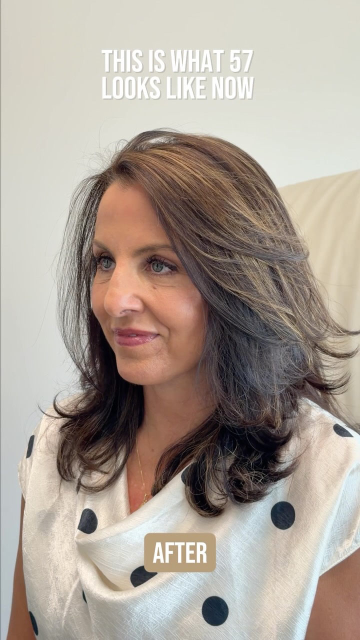 6 months out from a comprehensive facial rejuvenation — and the results speak for themselves 🙌🏼
She came in bothered by laxity along the jawline and neckline. That quiet, gradual change that doesn’t happen overnight (but feels like it does!) and then one day just stops matching how you feel on the inside.
We addressed the structure. The integrity layers that had fallen with time, put back where they belong. This isn’t just skin; it’s a comprehensive repositioning of deeper layers. The result is sharper, more defined, and most importantly still completely her.
Procedures performed:
🔹 Preservation deep plane facelift
🔹 Deep neck lift
🔹 Temporal brow lift
🔹 Chin Augmentation
🔹 Lip lift
🔹 Buccal Fat Pad Removal
As always, I’m here for questions 💬
📍 @memorialplasticsurgery | #houstonplasticsurgeon