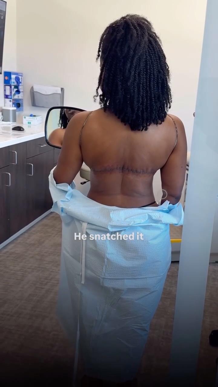 The Upper Bra Line Back Lift is one of the most under-appreciated procedures in post-weight loss surgery.

However, when there is significant degree of loose, excess skin, this procedure is the only option to achieve real improvement and tight contour. 💯

3 months ago I posted this patient explaining that the only way to address loose skin in the upper back is to put a scar there - hidden along the bra line. She had already had a Lower Circumferential Body Lift (done by me) and was ready to complete her transformation 🔥

This is the reveal at 3 weeks post-op! Incision is hidden, flat, and exactly where it needs to be. Her reaction says everything! 🙏🏼

Procedure: Upper Bra Line Back Lift

@memorialplasticsurgery | #backlift #bodycontouring #skinremoval #weightloss #houstonplasticsurgeon