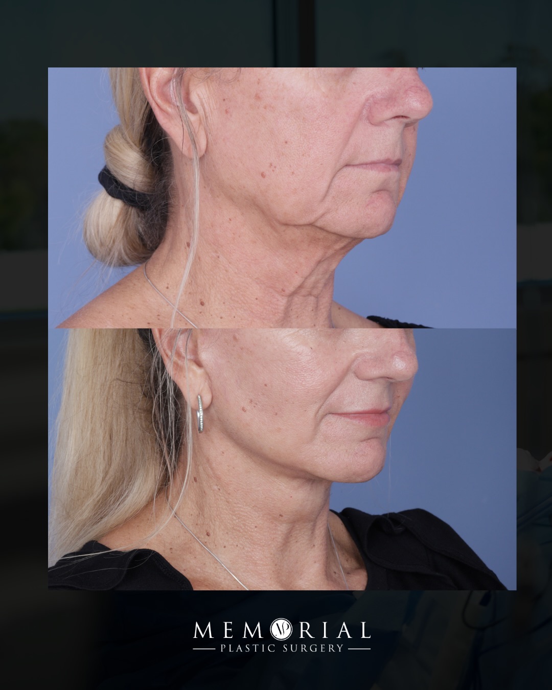 6.5 months out. And that neckline speaks for itself.
This wonderful 65-year-old patient came in with early jowling obscuring the sharpness along her jaw and a neckline that had lost its angle over time.
The structure is back. The definition is there. Still looks exactly like herself; just the best version of it.
Procedure(s) performed:
🔹 Preservation Deep Plane Facelift
🔹 Deep neck lift
🔹 Temporal brow lift
🔹 Upper blephs
🔹 Lower blephs
🔹 CO2 laser resurfacing
Questions below 💬
📍 @memorialplasticsurgery | #houstonplasticsurgeon
