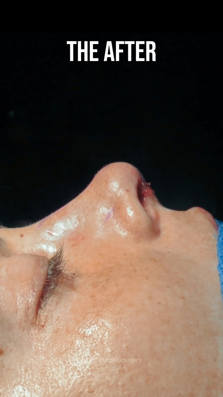 The first look. 👃🏻
This wonderful 25-year-old came in bothered by a dorsal hump and a tip that needed refinement. A nose that just didn’t feel like it fit the rest of her face.
We’re stoked at the on the table result, even with some early swelling starting. But it already fits her face like it was always supposed to be there.
Procedure(s):
🔹Open septorhinoplasty
I’m answering everything below 💬
📍 @memorialplasticsurgery | #houstonplasticsurgeon