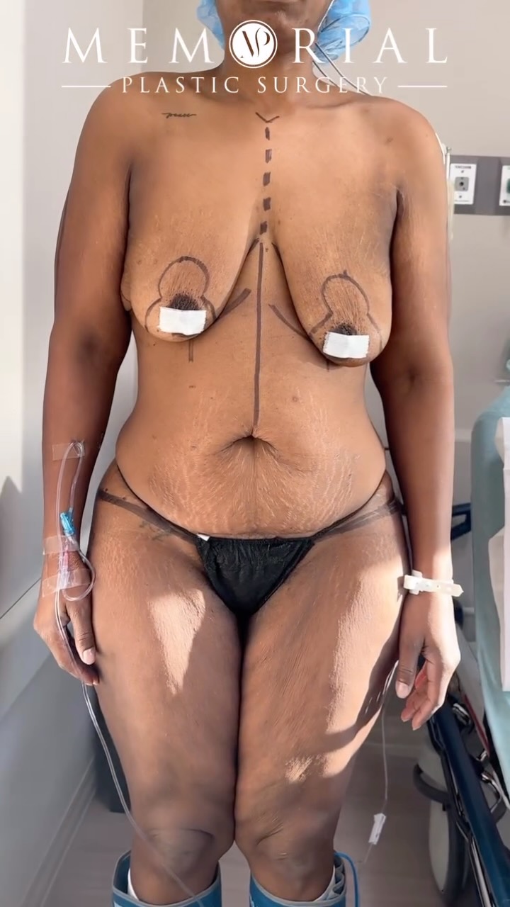 Another beautiful transformation for my lovely patient! 😍😍🙌🏼

Procedure: Circumferential Body Lift, Breast Lift w/ implants, BBL + Lipo360 💖
(Pre-Sx Wt: 181lbs Ht: 5’8 BMI: 27.5)

#beforeandafter #mommymakeover #transformation #newbody #houstonplasticsurgeon @memorialplasticsurgery
