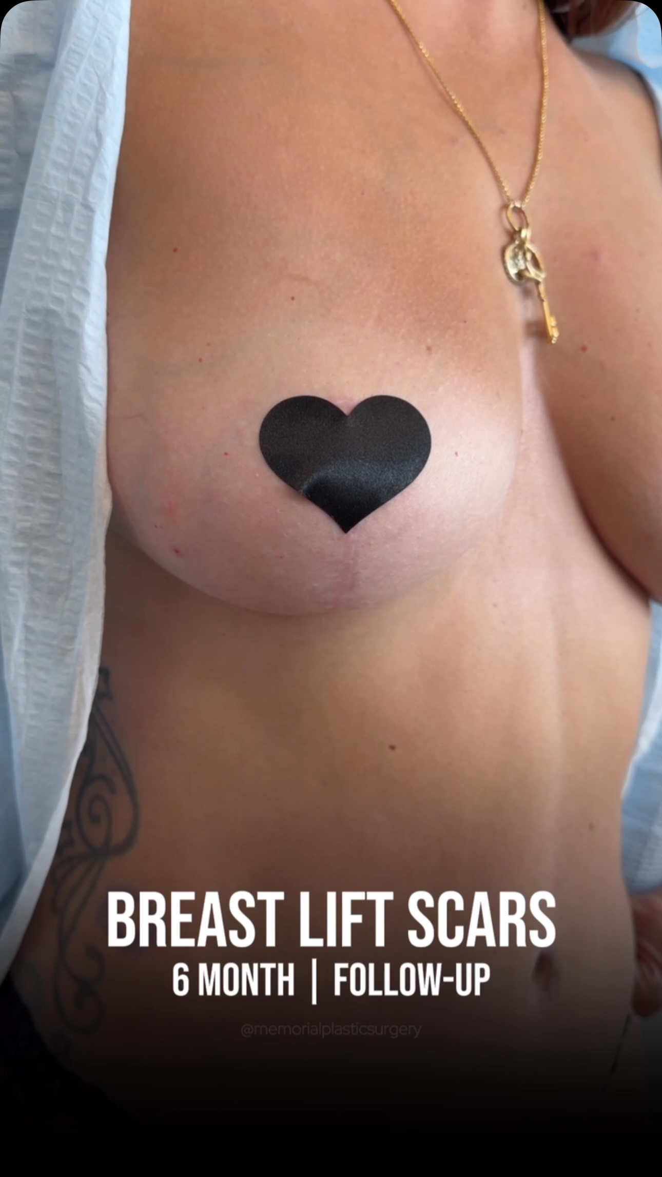 6 months after a breast lift — and this is what the scars look like. ☝🏻
At 6 months post-op we’re in a great place — but there’s still more to come. Scars continue to soften and fade for another 6 to 12 months from here.
What you see now is not the final result. Patience is part of the process — and it’s always worth it. 🙏🏼
📍 @memorialplasticsurgery | #breastlift #mastopexy #houstonplasticsurgeon