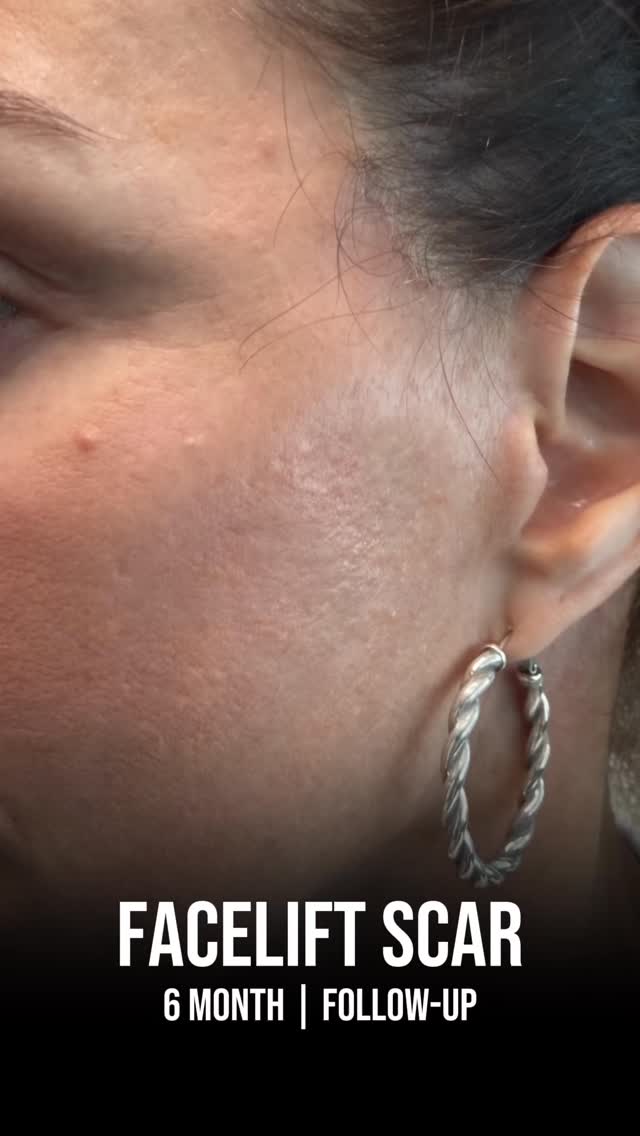 I spy a deep plane facelift incision. 👀
6 months out. Find it if you can.
Drop yours below — I read every single one 💬
📍 @memorialplasticsurgery | #houstonplasticsurgeon
