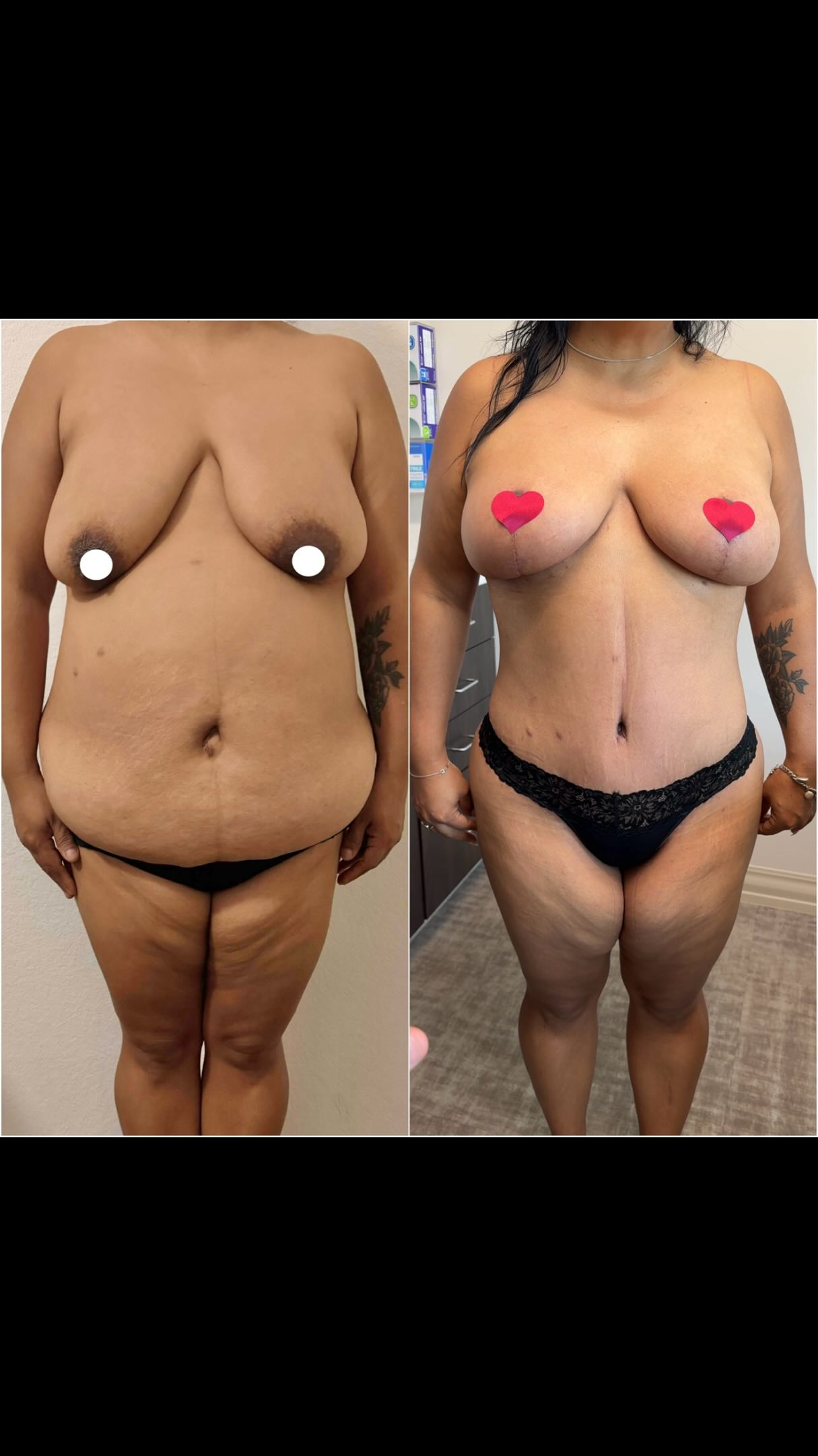 I love these major transformations because they are truly life changing! 🔝
6 weeks following her mommy makeover, and my patient is healing beautifully. 🔥💯
Procedures (all in one stage): Extended Tummy Tuck, Lipo to the abdomen & Flanks, and Breast Lift.
📍 @memorialplasticsurgery | #mommymakeover #tummytuck #breastlift #bodycontouring #houstonplasticsurgeon
