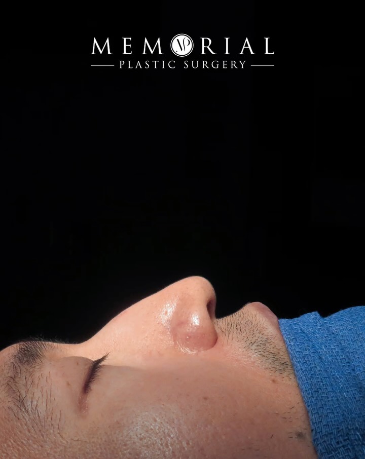Fresh off the table. 👃🏻
This one had a few curveballs — a previous septoplasty with a fractured anterior septal angle that required near complete reconstruction before we could even get to the cosmetic work.
Not just reshaping. Rebuilding from the foundation up to make a stronger and more refined nose.
Procedure(s) performed:
🔹 Open septorhinoplasty
🔹 Septal reconstruction
Questions below 💬
📍 @memorialplasticsurgery | #houstonplasticsurgeon