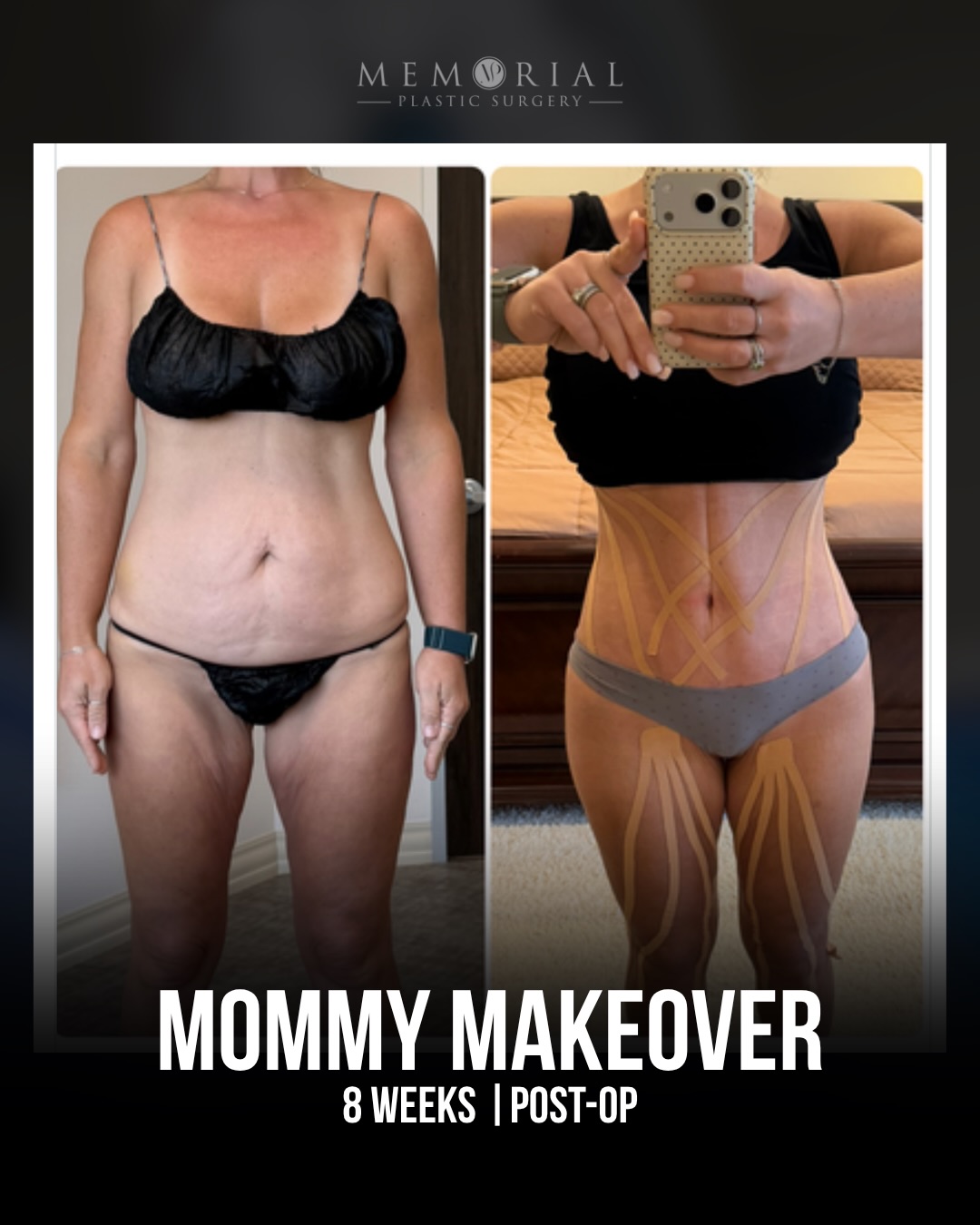 Out of state patient. 4 pregnancies, 3 C-sections, and 70 pounds lost after her last pregnancy. Ready for the last step. 🙌🏼

At 42, her goals were circumferential contouring, tighter skin, and reshaping what two decades of life had changed. We built a plan around all of it.

8 weeks post-op — and this is what she had to say on RealSelf. Slide to read. 🙏🏼

Procedures: Drainless Circumferential Body Lift, Lipo 360, BBL

(Pre-Sx Wt: 140 | Ht: 5’4 | BMI: 24)

📍 @memorialplasticsurgery | #houstonplasticsurgeon #bodylift #bodytransformation #bodycontouring
