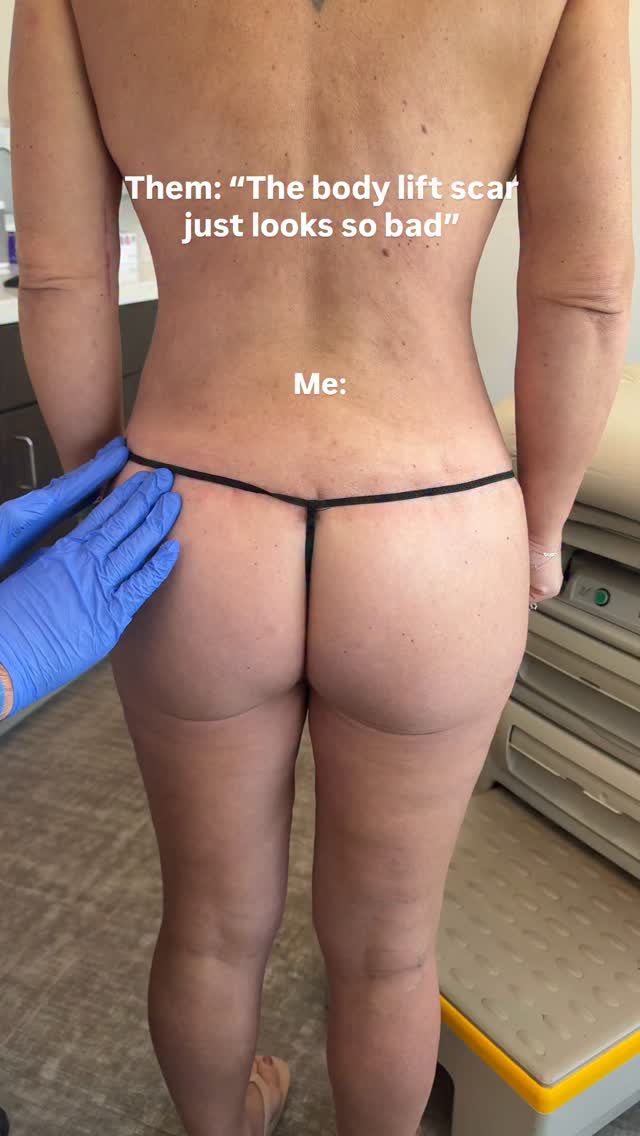 6 weeks post-op and this is what the body lift scar actually looks like 👇🏼

Low, thin, well-positioned. Still months away from its final appearance and already looking great 👏🏼

It only gets better from here! This is your sign to not let the scar steer you away from getting the surgery 🙏🏼

**NOTE: The arm lift (arm scars that you see in the video) was performed by a different surgeon at a different time**

📍@memorialplasticsurgery | #bodylift #scarhealing #bodycontouring #houstonplasticsurgeon