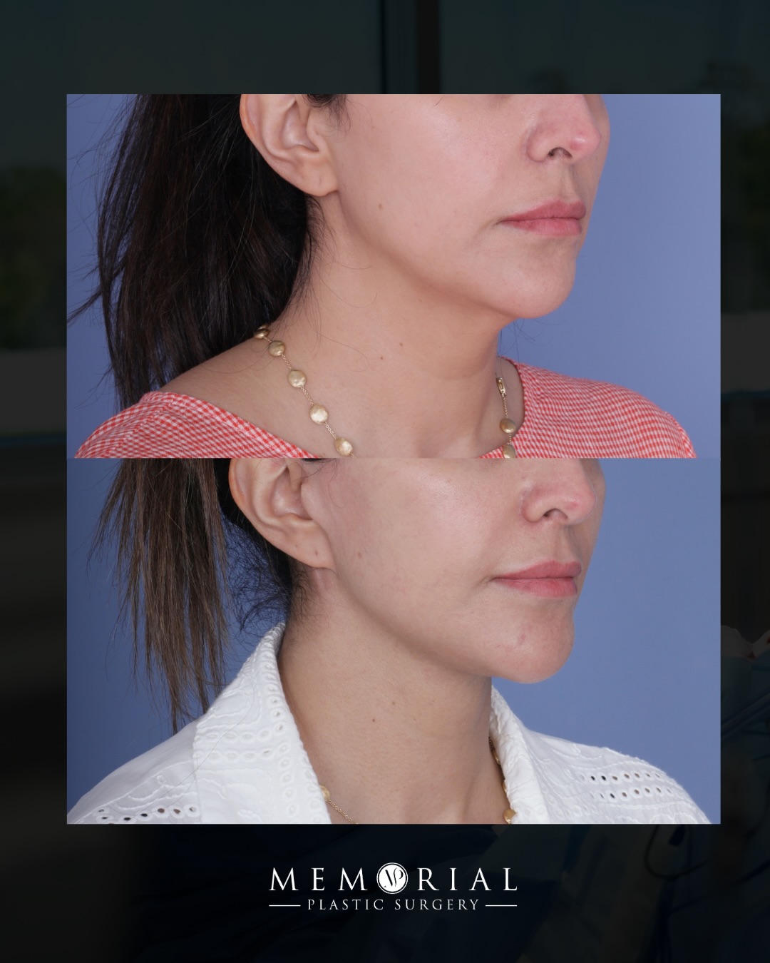 That jawline though 👌🏻
She came in with concerns about laxity along the jawline and neckline: that pesky early scalloping jowl and blunted angle in the neck that’s equal parts genetics and age.
6 months later, our neck & jawline are sharp, defined, and most importantly still hers.
Procedure(s) performed:
🔹 Deep plane facelift
🔹 Deep neck lift
🔹 Temporal brow lift
🔹 Fat grafting under eyes
Questions below 💬
📍 @memorialplasticsurgery | #houstonplasticsurgeon