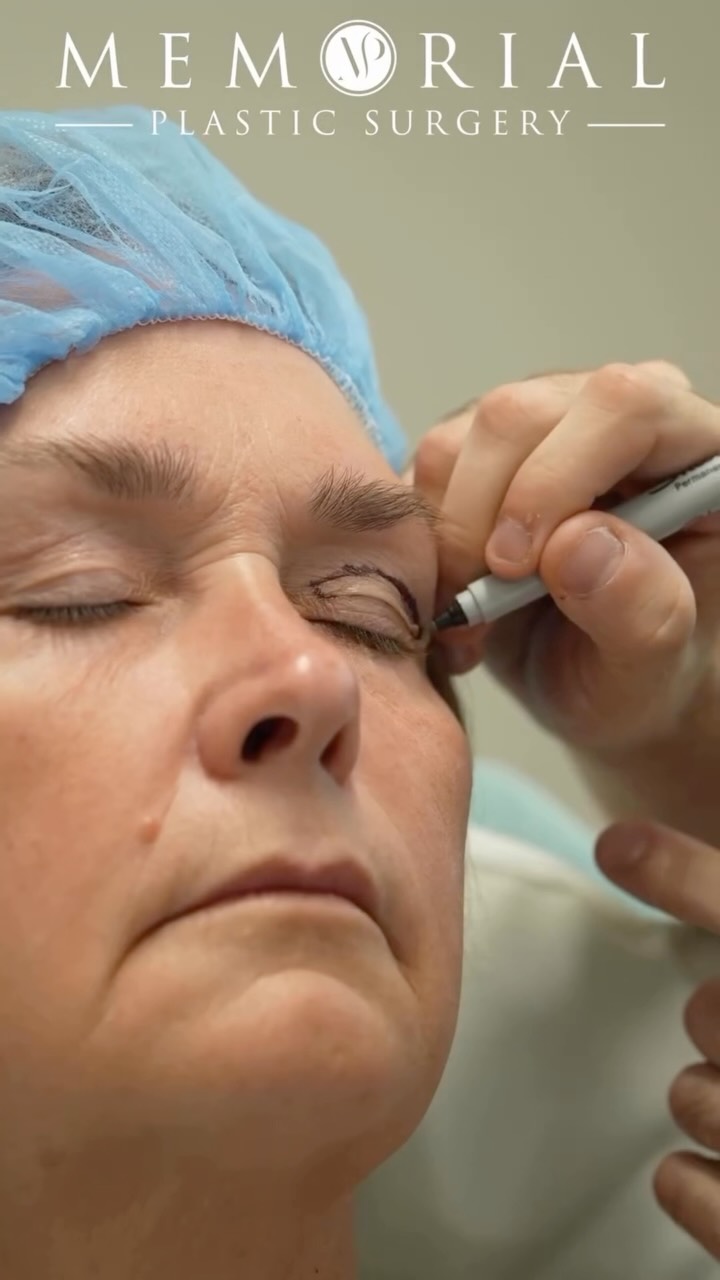 This is what the full picture looks like. ✨
Facelift. Neck lift. Upper lids. CO2 laser. Each procedure with its own job all working together toward one result.
Lifted where it needed lifting. Refreshed where it needed refreshing. And through it all still completely herself.
Procedure(s) performed:
🔹 Deep plane facelift
🔹 Deep neck lift
🔹 Upper lid blepharoplasty
🔹 Full face CO2 laser resurfacing
Questions below 💬
📍 @memorialplasticsurgery | #houstonplasticsurgeon #facesurgeon #facesurgery