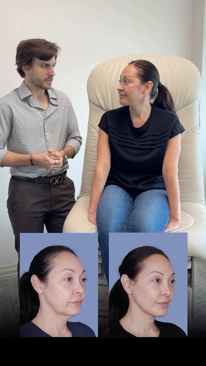 Testimonial Tuesday 🎙️
“I was looking in the mirror and not recognizing myself — not feeling on the outside how I felt on the inside.”
3 months out? “I feel as great as I look.”
That’s the result we’re always chasing. 🙌🏻
Procedure(s) performed:
🔹 Deep plane facelift
🔹 Deep neck lift
🔹 Lower pinch Bleph
🔹 Chin Augmentation
As always, I’m here for questions 💬
📍 @memorialplasticsurgery | #houstonplasticsurgeon