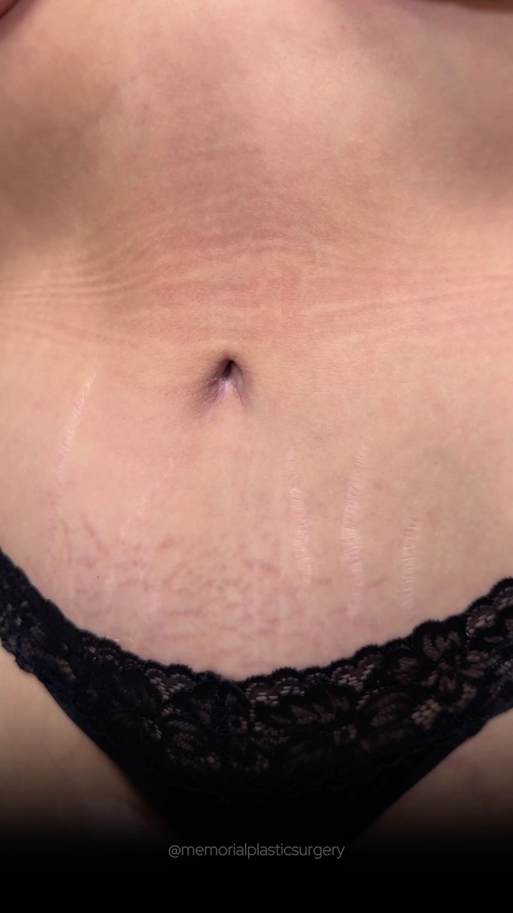 5 weeks out and already stunning. 🤍

Lipo 360, breast lift and tummy tuck on a mom of three — and she is healing beautifully. The shape, the contour, everything is coming together exactly the way we planned.

And that belly button? One of my favorites 😍

Procedures: Lipo 360 | Bilateral Mastopexy | Abdominoplasty
(Pre-Sx Wt: 168 | Ht: 5’4 | BMI: 28.9)

📍 @memorialplasticsurgery | #houstonplasticsurgeon