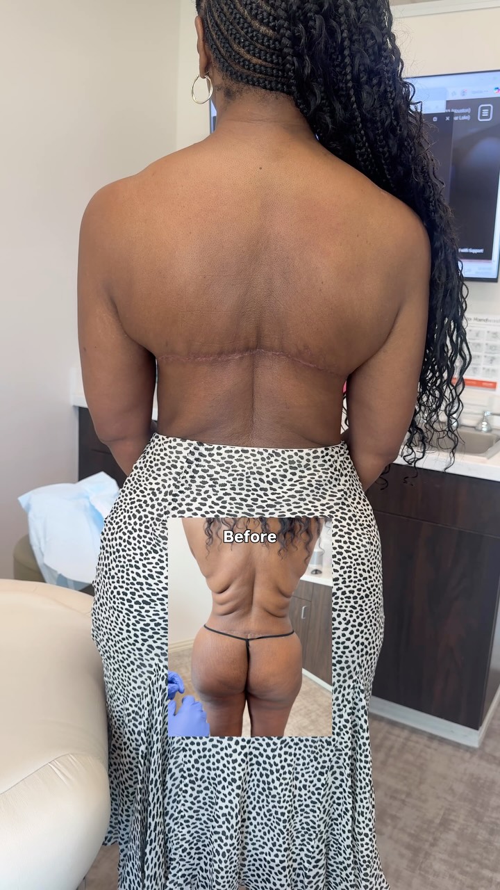 The post featuring my patient from last month had lots of comments about the incision for this procedure. The concern was valid — a bra-line back lift does leave a scar. But placement is everything. 

This is her update. The scar is exactly where it should be 🙏🏼 
Hidden under the bra line, flat, and continuing to fade with every passing week 👏🏼👏🏼

Procedure: Upper Bra-Line Back Lift

Goal: Thin & Tight! 

📍 @memorialplasticsurgery | #backlift #bodycontouring #skinremoval #weightloss #houstonplasticsurgeon houstonplasticsurgeon