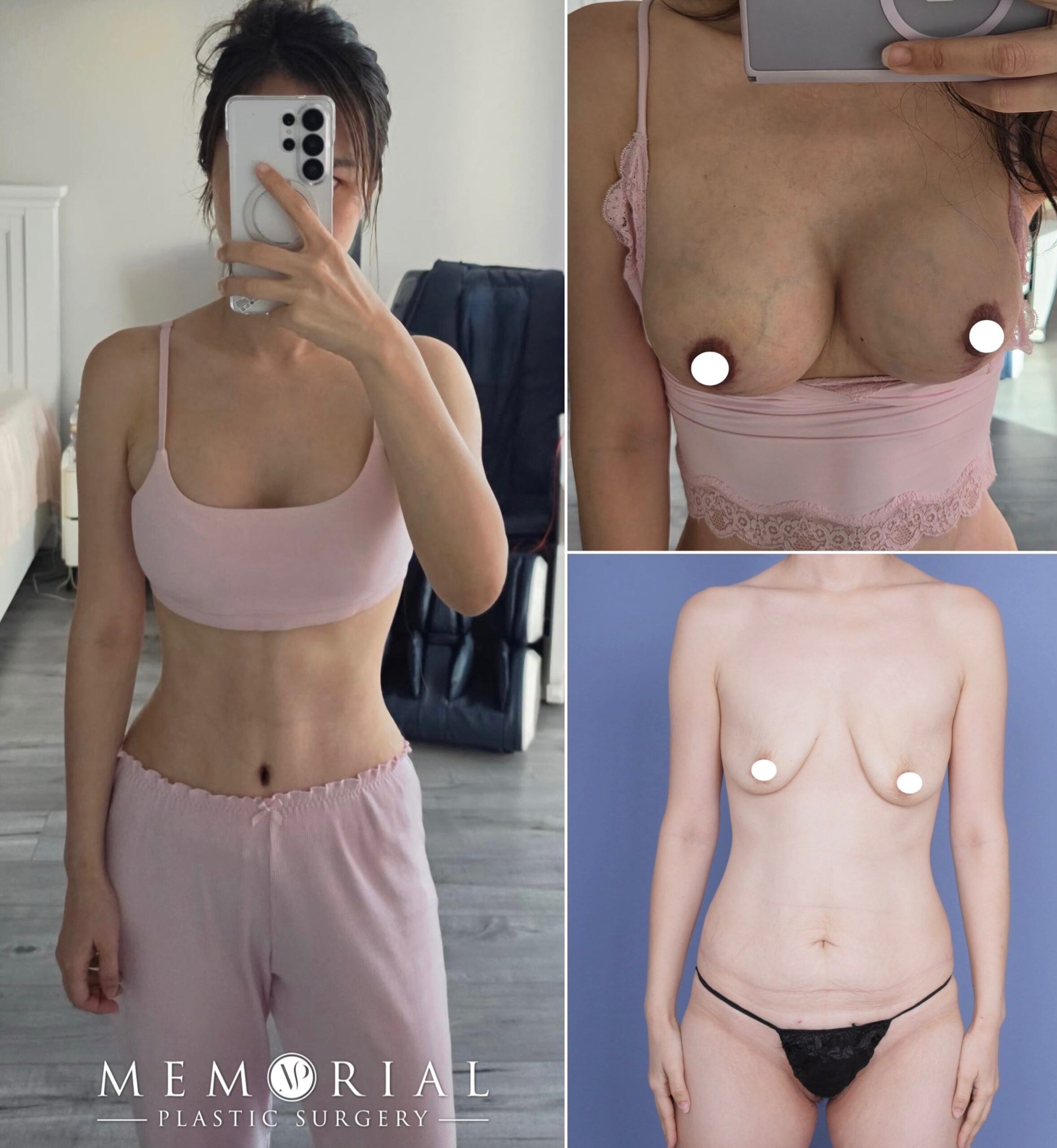 1.5 months post-op from #mommymakeover surgery, and my patient, a mother of 3, is feeling confident and looking great. 🔝🔥

Her result is already everything she came in for. All her goals were achieved: 

Her breasts are tight and nipples are lifted at the center of her breasts. Also, using implants we were able to achieve fullness in the cleavage and upper pole areas. 

Her abdomen is toned and her contour is both feminine and athletic, while her belly button looks normal. 

Procedures: Drainless Tummy Tuck with Lipo to her Flanks & Abdomen, Breast Lift & Breast Augmentation using 315 cc Motiva implants. 

📍 @memorialplasticsurgery | #transformation #houstonplasticsurgeon #tummytuck #breastliftwithimplants