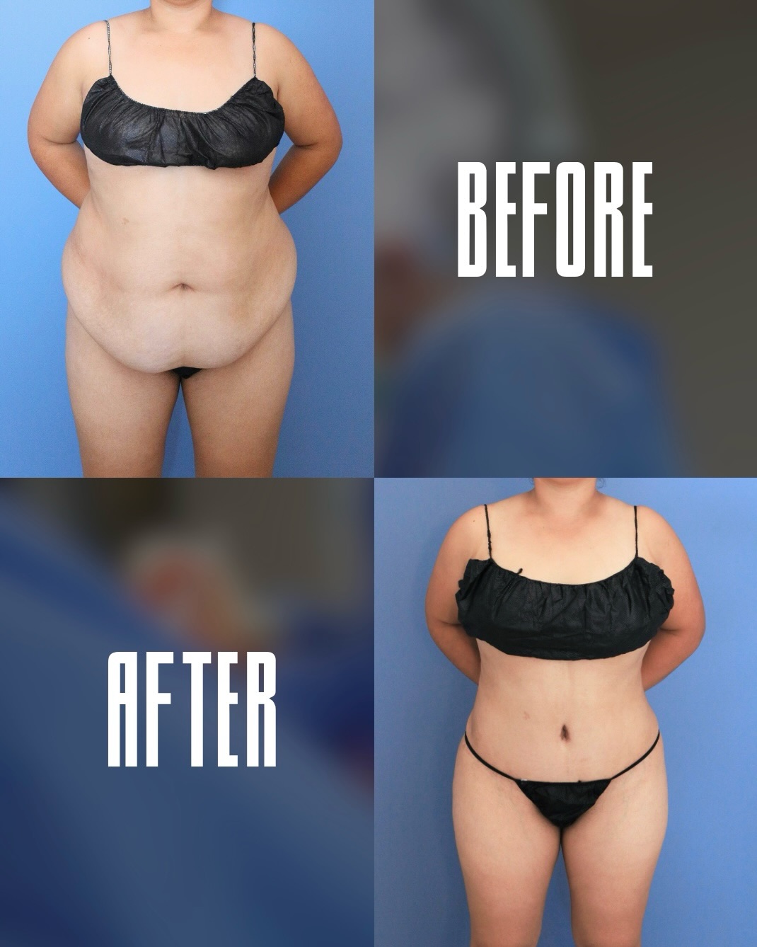 I love these dramatic body transformations because they are truly life changing. Here, my patient is at 7 months post-op after an extended tummy tuck 🙏🏼

The entire loose excess skin removed from the abdomen, and the abdomen, flanks & waist were further contoured with liposuction. 

The swelling has settled and the scar is well on its way to fading 🔥

The goals of tummy tuck surgery are a natural and athletic contour, tight and thin abdomen, normal-looking belly button and a low scar that can be hidden below thin underwear and swimwear. 

Procedures: Extended Abdominoplasty, Lipo to Abdomen & Flanks

📍 @memorialplasticsurgery | #tummytuck #abdominoplasty #houstonplasticsurgeon #bodycontouring #transformation