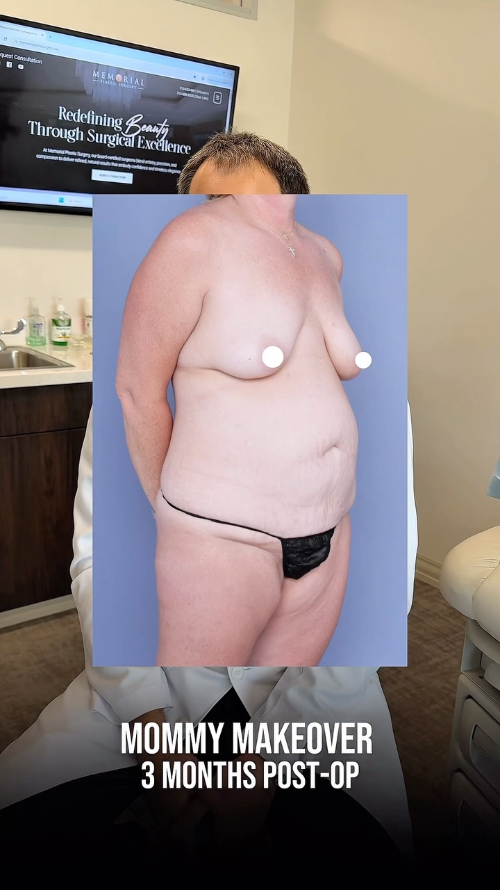 Treating women following significant weight loss is a passion of mine. A mommy makeover isn’t just one procedure, it’s a full plan combining multiple procedures to address multiple areas.☝🏼 

After 80 pounds of weight loss my amazing patient, a mother of one, came to me for full body and breast rejuvenation and enhance her contour to reflect the hard work she had put in! 

Removing excess skin while simultaneously restoring volume and shape is required for a beautiful transformation. And now this is her at 3 months, and looking spectacular!🔥

Procedures: Drainless Circumferential Body Lift, BBL, Lipo 360, J-Plasma to Back, Breast Lift & Breast Augmentation 340cc & 360cc Motiva Implants, and Fat Grafting to the Breasts

📍 @memorialplasticsurgery | #mommymakeover #bodylift #weightloss #breastliftwithimplants #houstonplasticsurgeon