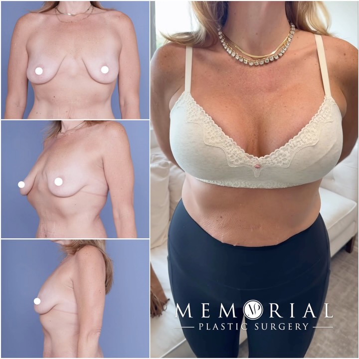 After losing 170-lbs, my beautiful patient wanted to improve the appearance of her breasts. The goal was to both tight the breasts and provide fullness. To achieve this, a breast lift with implants was performed, also an internal bra was placed for long term support. 🙏🏼

The implants are Motiva, 575cc on the left and 525cc on the right, chosen to balance her natural asymmetry. The internal bra technique provides additional lower pole support. 💯

Procedures: Bilateral Breast Lift (Mastopexy) with Breast Augmentation (Motiva 575cc L / 525cc R) & Internal Bra Technique. 

📍 @memorialplasticsurgery | #breastliftwithimplants #breastisbest #mastopexy #motivaimplants #houstonplasticsurgeon