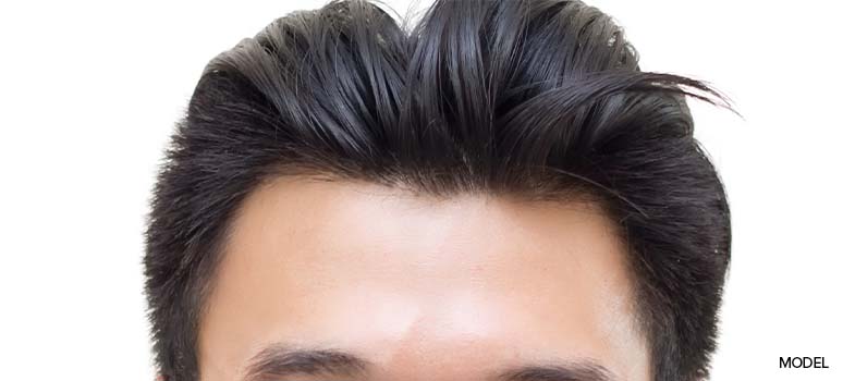 hair transplant after ten years