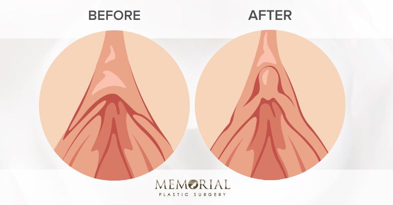 Clitoral Hood Reduction Illustration Houston