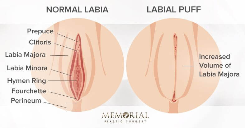 Labia Puff Before And After Diagram