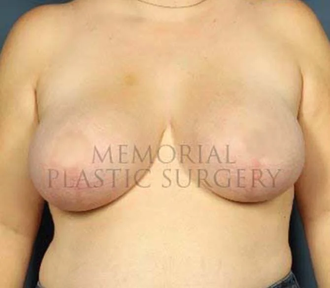 Breast Reduction After