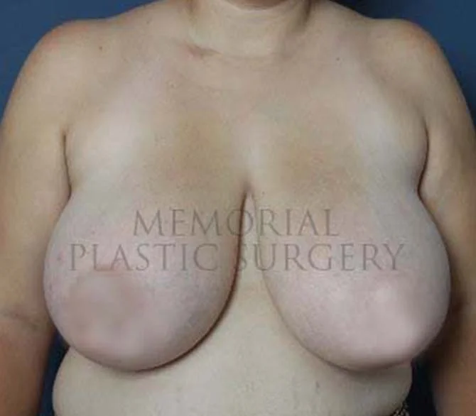 Breast Reconstruction