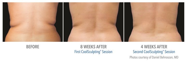 Coolsculpting Before And After Photo