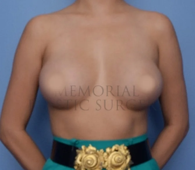 Breast Augmentation