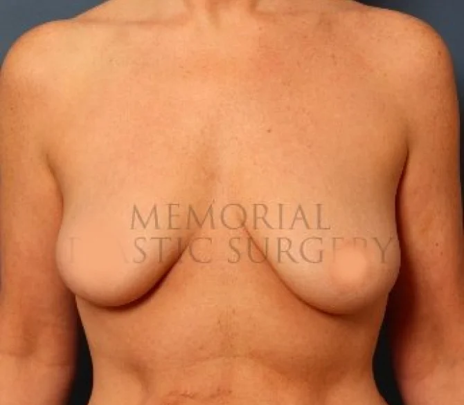 Breast Lift Before