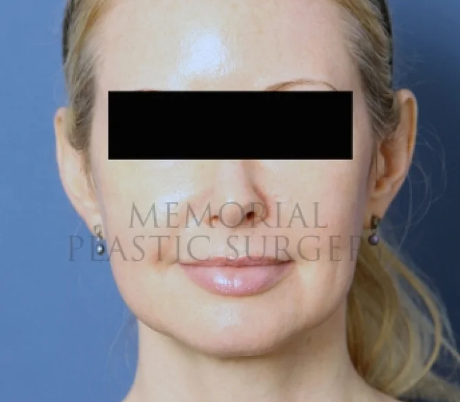 Chin Augmentation After