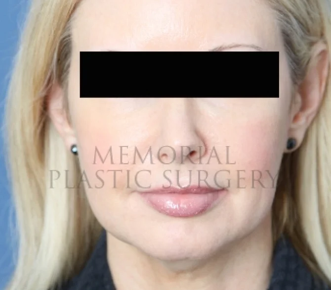 Chin Augmentation Before