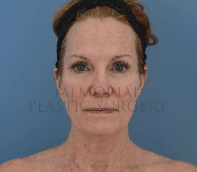 Facelift Before