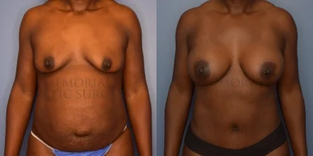 BREAST AUGMENTATION BEFORE AND AFTER