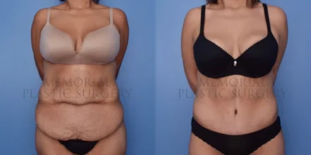 TUMMY TUCK BEFORE AND AFTER