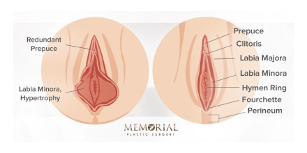 Labiaplasty