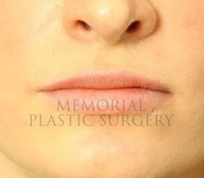 Lip Augmentation