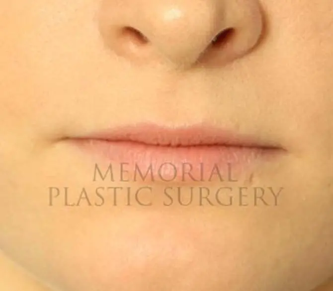 Lip Augmentation Before