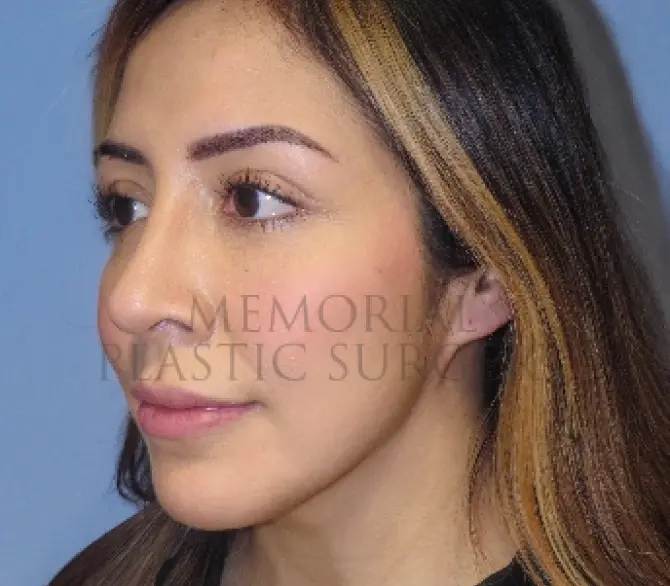 Rhinoplasty After