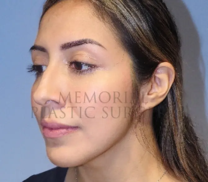 Rhinoplasty Before