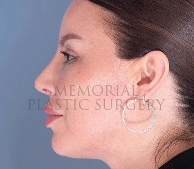 Septoplasty after