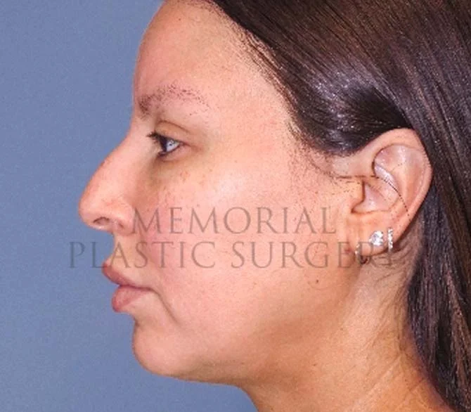 Septoplasty before