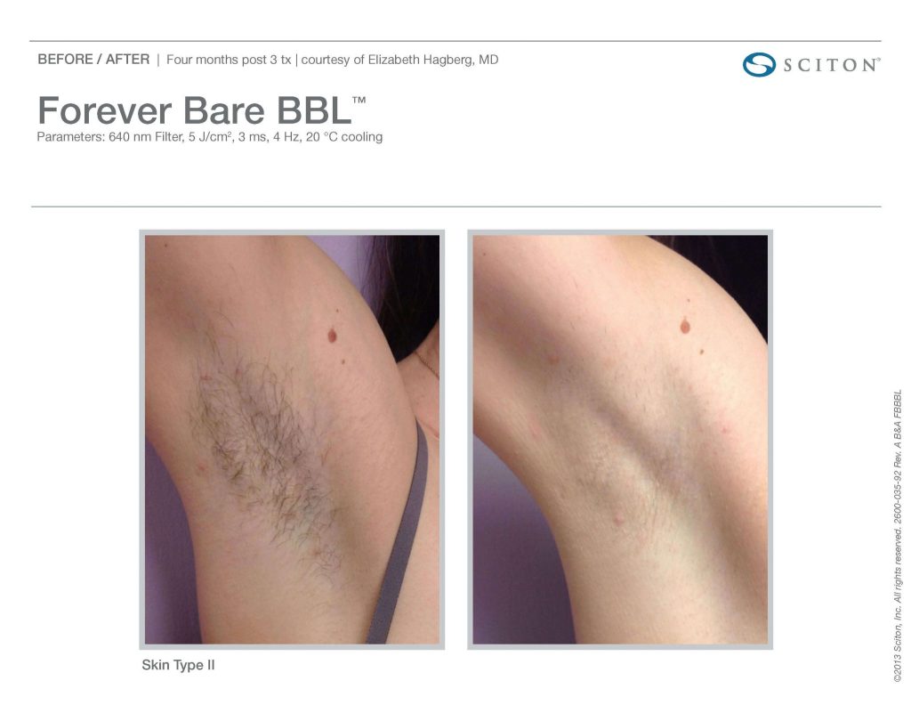 Laser Hair Removal Armpit