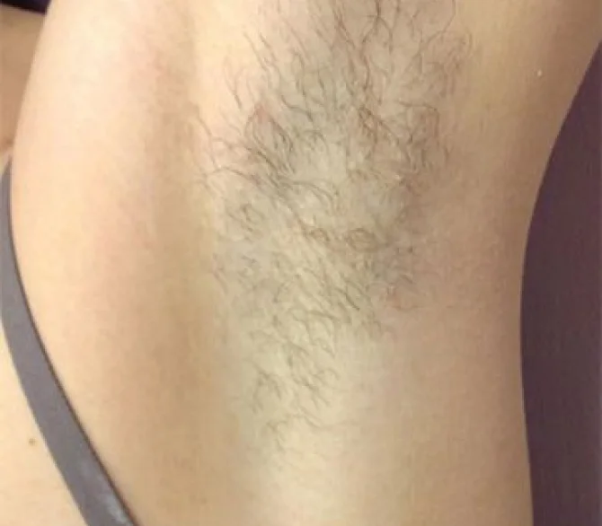 Laser Hair Removal Before